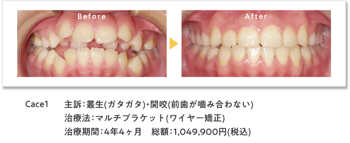 ワイヤー症例1