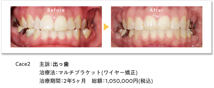 ワイヤー症例2