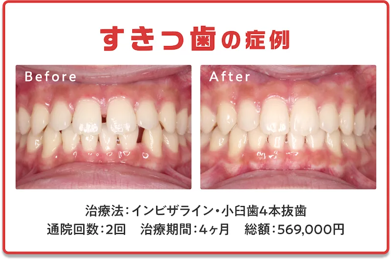 症例7 すきっ歯