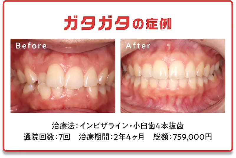 症例3　ガタガタ