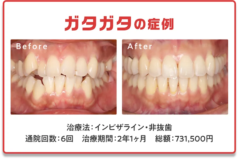 症例4　ガタガタ