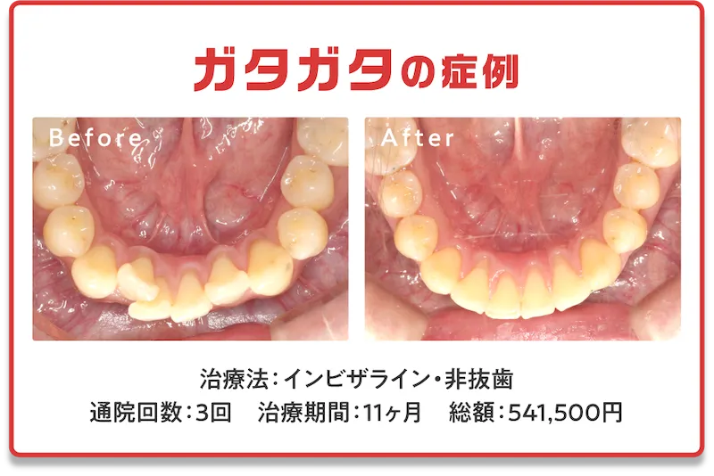症例2　ガタガタ