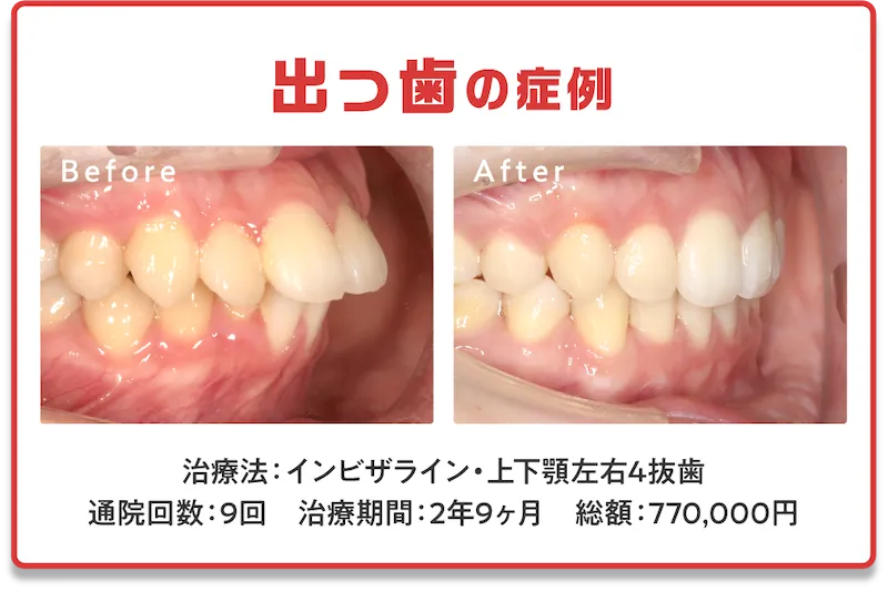 症例1　出っ歯