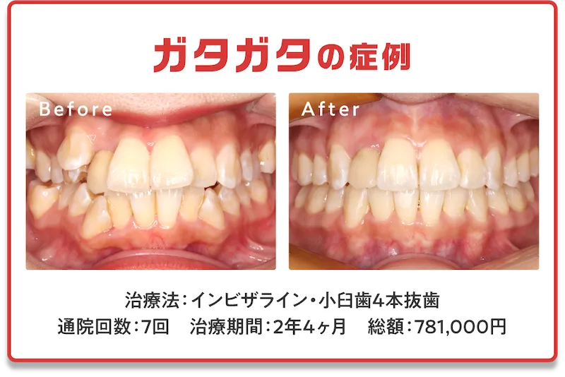 症例6　ガタガタ