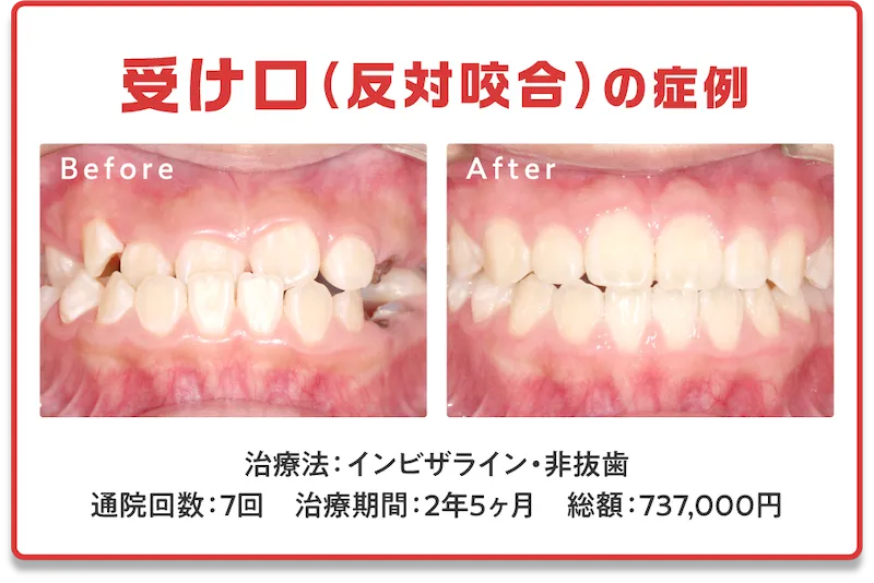 症例9　受け口
